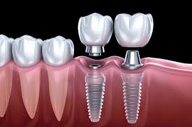 Dental Implants — Dentist4u